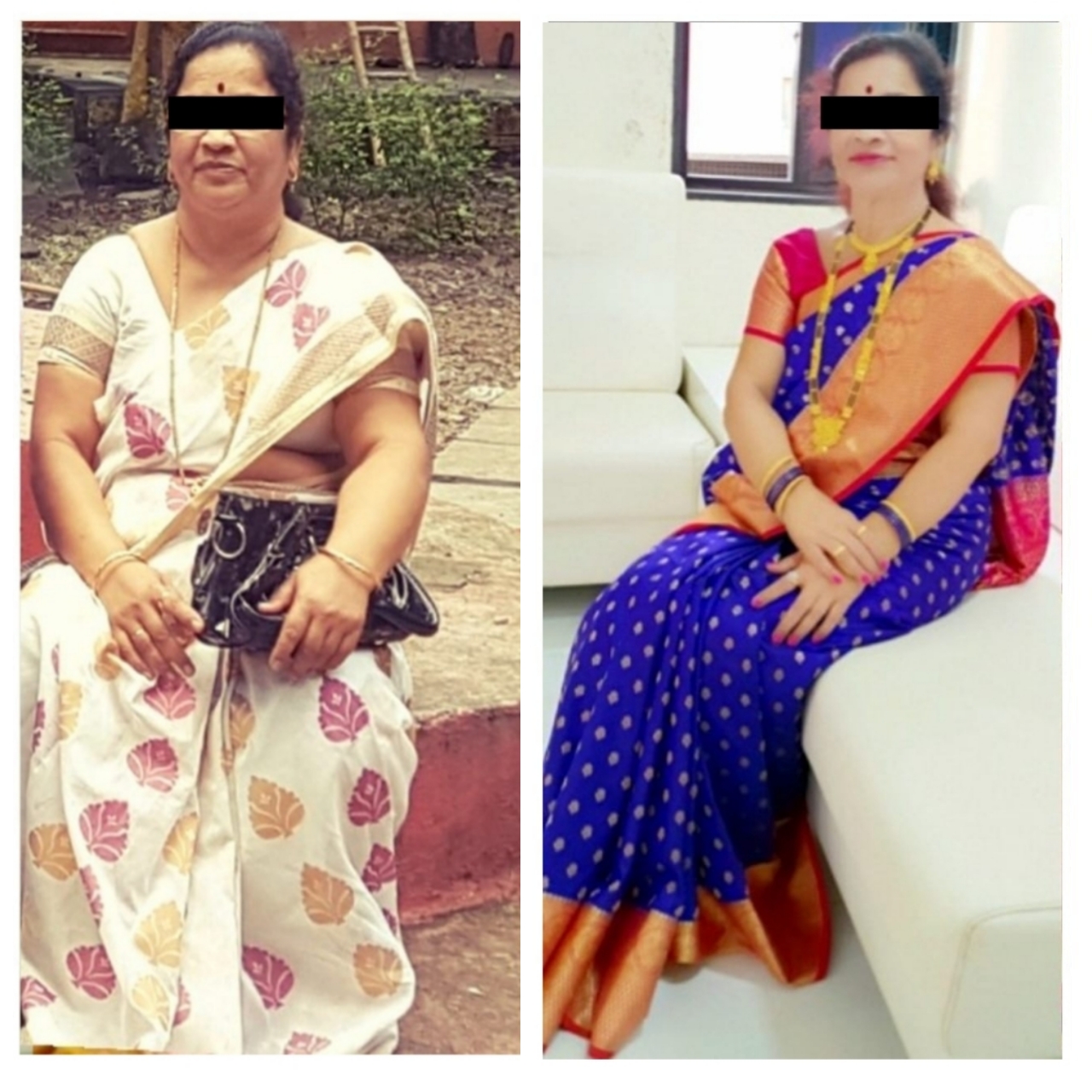 Jupiter Hospital - Bariatric Surgery Before and After