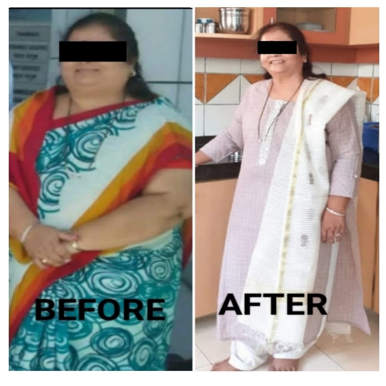 Jupiter Hospital Bariatric Surgery Before and After -5